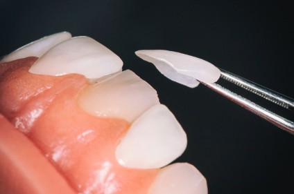 Установка виниров в СПб