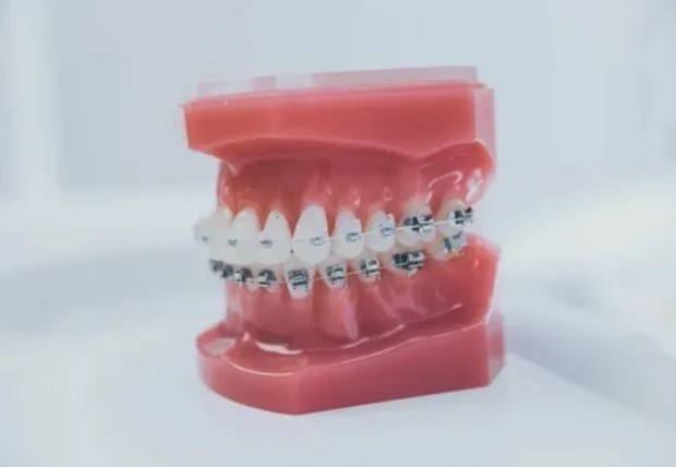 Исправление прикуса брекетами